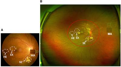 Cross-modality transfer learning with knowledge infusion for diabetic retinopathy grading